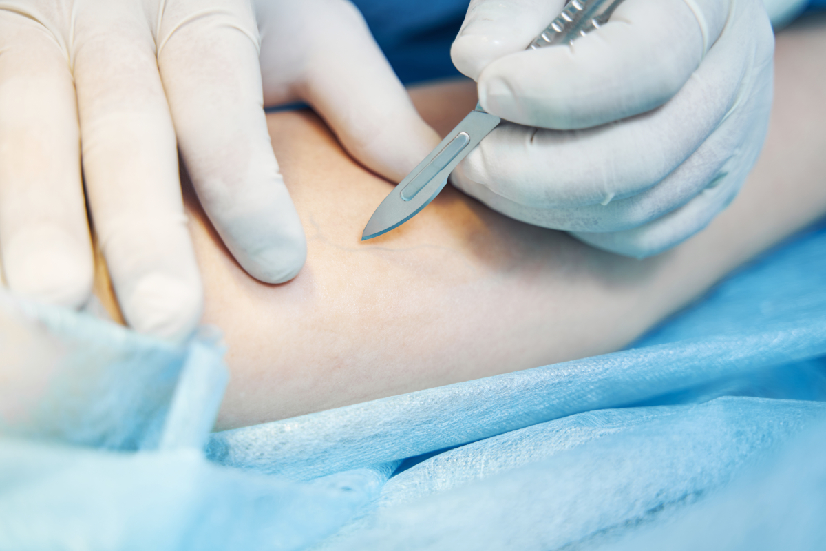 point de suture résorbable